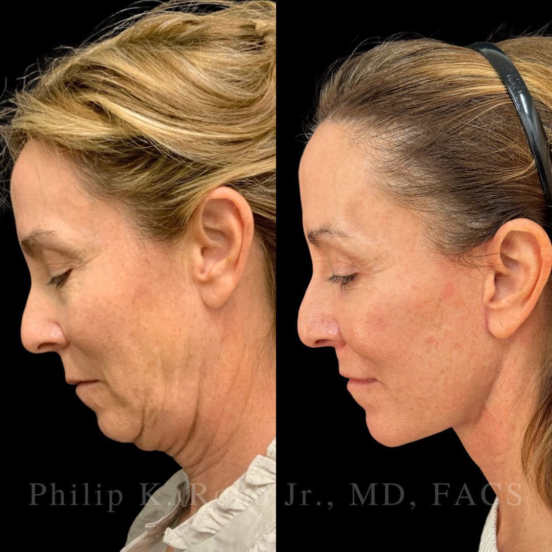 RobbJrMD's tweet image. Catherine, 55 yrs old!🤩

Catherine's main concern was her neck but she wanted an overall "refresh"🙌🏼

Robb Refresh🙏🏼
