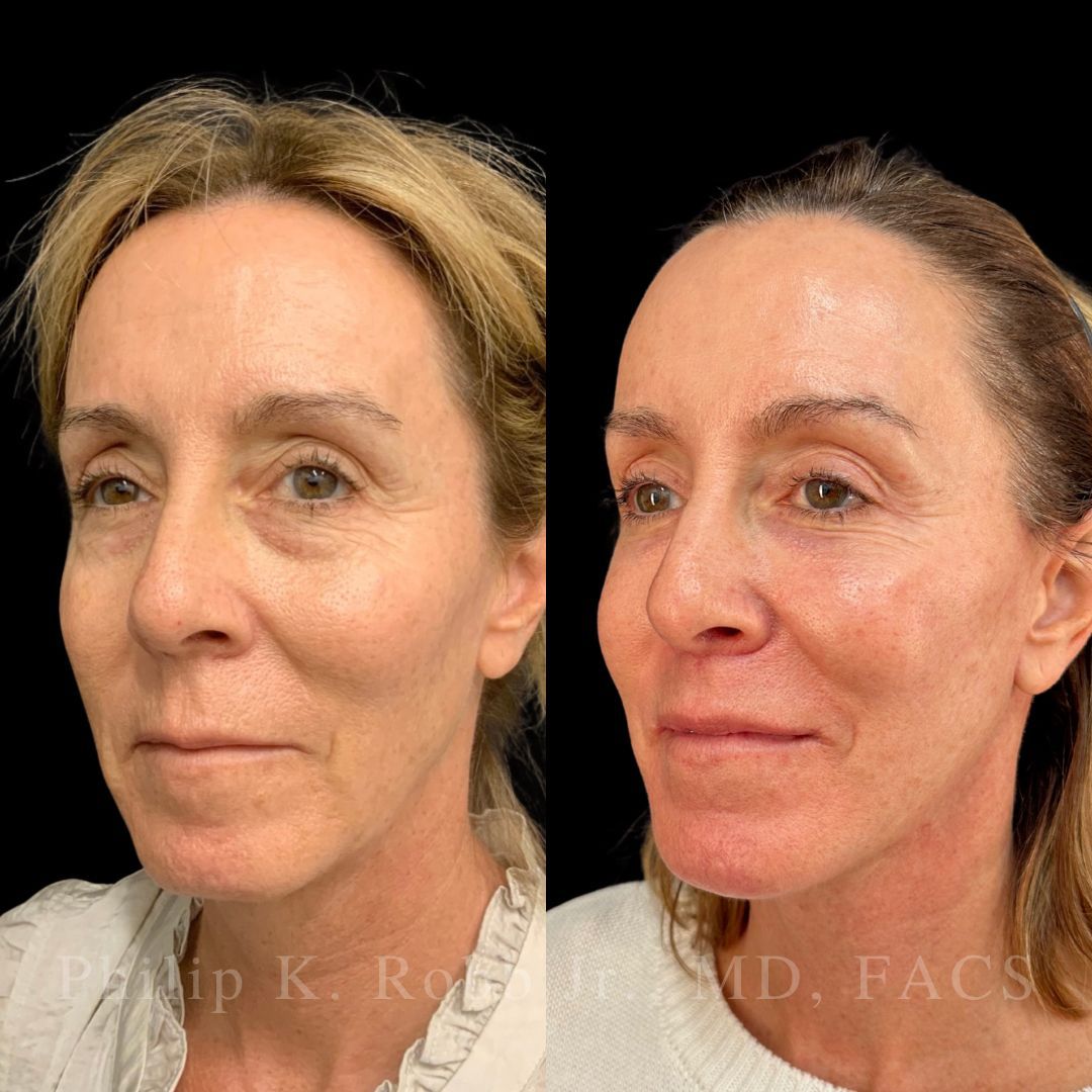 RobbJrMD's tweet image. Catherine, 55 yrs old!🤩

Catherine's main concern was her neck but she wanted an overall "refresh"🙌🏼

Robb Refresh🙏🏼