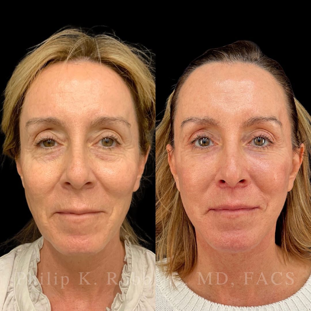 RobbJrMD's tweet image. Catherine, 55 yrs old!🤩

Catherine's main concern was her neck but she wanted an overall "refresh"🙌🏼

Robb Refresh🙏🏼