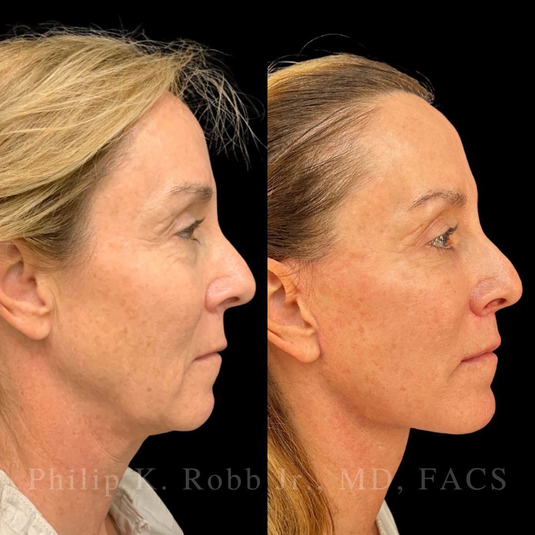 RobbJrMD's tweet image. Catherine, 55 yrs old!🤩

Catherine's main concern was her neck but she wanted an overall "refresh"🙌🏼

Robb Refresh🙏🏼