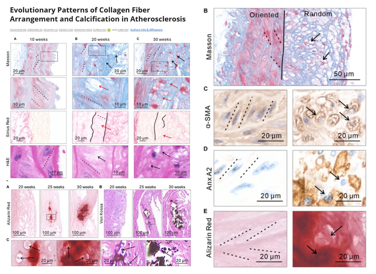 HaoYin20's tweet image. The quantitative analysis of Re-orientation of #SmoothMuscleCell #CollagenFiber in🐭#Atherosclerosis

#Calcification Annexin A2/5/6 (#MatrixVesicle markers)⬆️ only seen in zones of SMC/Collagen disorganization

Xufeng Niu &amp;amp; Yubo Fan labs Research 2025
spj.science.org/doi/10.34133/r…