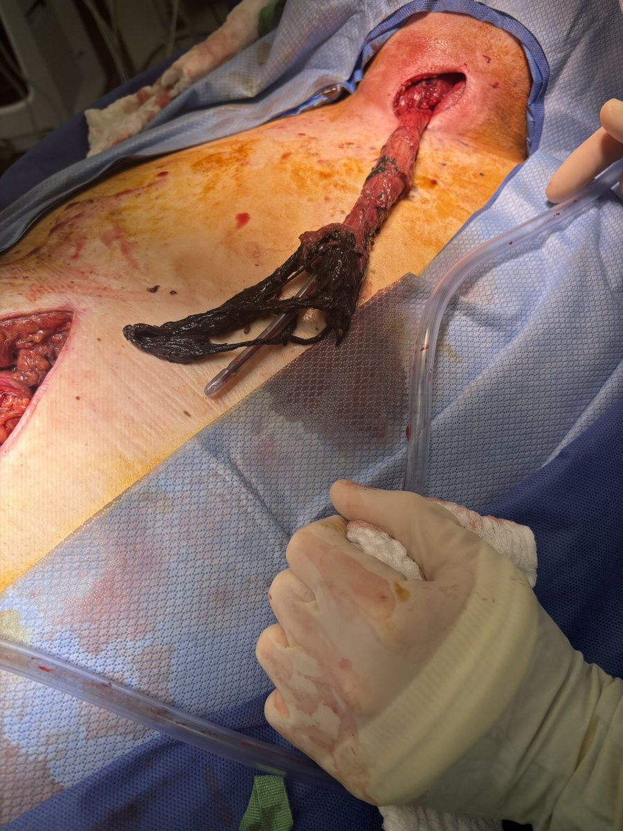 Elliot Servais, MD, FACS tweet media