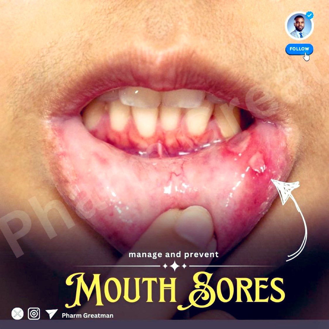 OGreat6's tweet image. MOUTH SORES

Have you ever had a painful sore pop up in your mouth, making eating and talking a struggle? 

Here is everything you need to know about mouth blisters. Learn what causes them, how to treat them, home remedies, and ways to keep them away!

Check my comments below 👇🏾