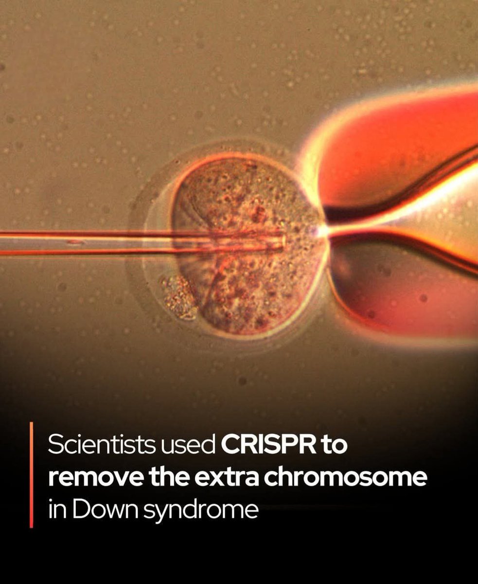 ShiningScience's tweet photo. 🚨 CRISPR was just used to delete the extra chromosome behind Down syndromefor the first time in history.

In a stunning scientific milestone, researchers have used CRISPR gene editing to delete the extra chromosome that causes Down syndrome. 

Known as trisomy 21, the condition arises from an additional copy of chromosome 21, which leads to a range of developmental and health issues. 

Using cells derived from individuals with Down syndrome, scientists successfully removed the third chromosome in both stem cells and skin cells. The edit not only eliminated the extra chromosome but also restored normal gene expression—something never before achieved at this scale.

The process involved precisely timed CRISPR-Cas9 edits and a temporary suppression of the cells’ DNA repair mechanisms to enhance precision. While this breakthrough remains in the lab, it offers a potential pathway toward future therapies for genetic disorders long considered untreatable. If refined and proven safe, this technique might one day be applied to critical brain cells or even used prenatally. Beyond Down syndrome, the approach could pave the way to addressing other severe trisomies, such as 13 and 18, which are often fatal early in life.

Source:
Trisomic rescue via allele-specific multiple chromosome cleavage using CRISPR-Cas9 in trisomy 21 cells. PNAS Nexus, 2025
