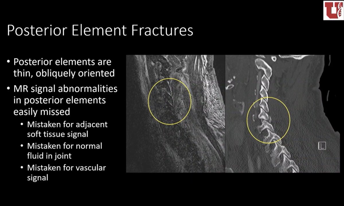 francisdeng's tweet image. Some significant C-spine injuries are occult on MRI. Key example is fracture of the posterior elements, which have little marrow with which to show edema signal.

@lubdha_shah on cervical spine misses at #RSNA2025