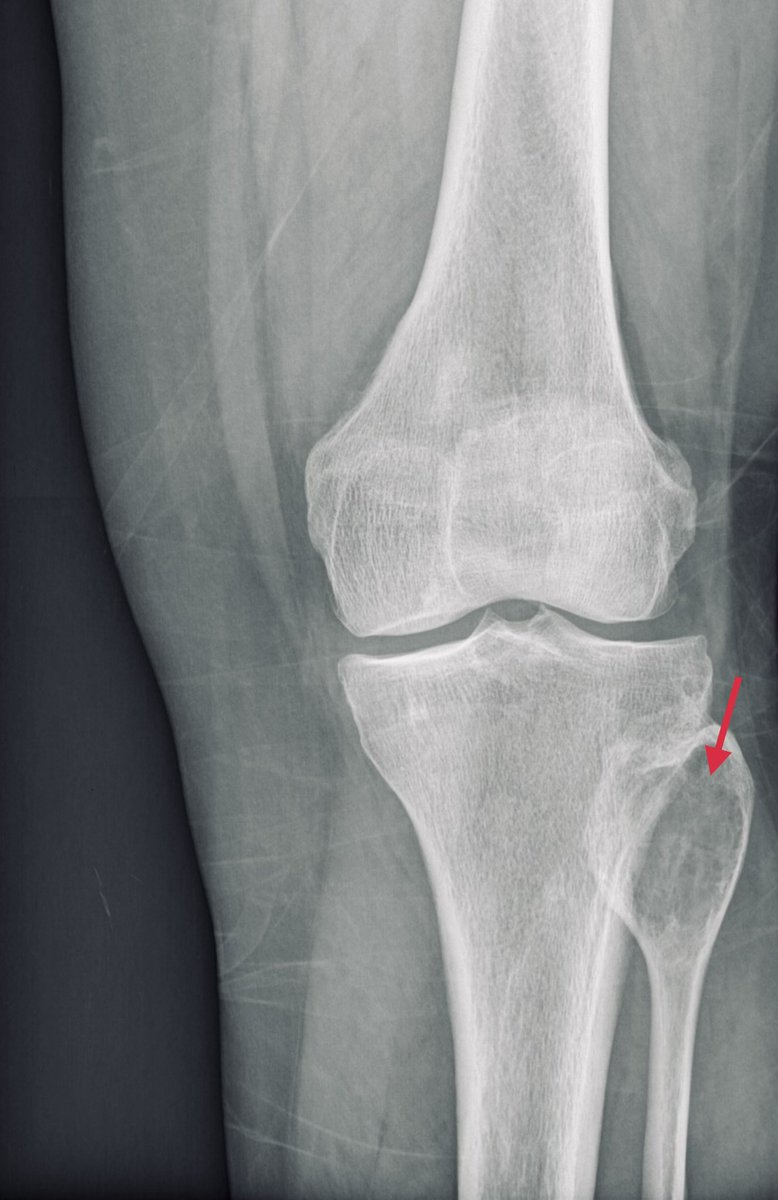 docxusofficial's tweet image. Epiphysis… eccentric… lytic lesion

What tumor is it?