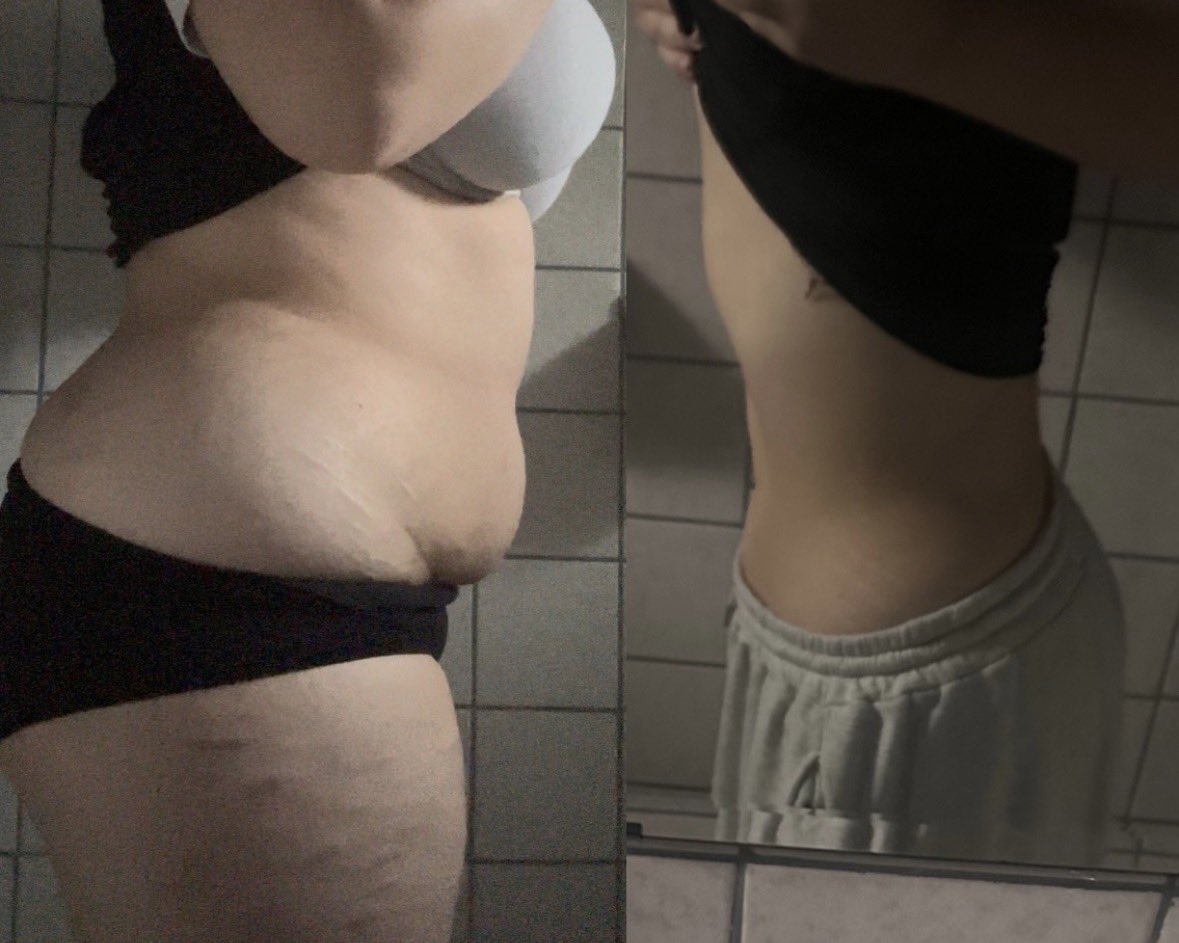 Username001870's tweet image. There’s a difference….right? I’m going crazy. The second I feel good I see it but as soon as I eat I feel like it still looks the same.