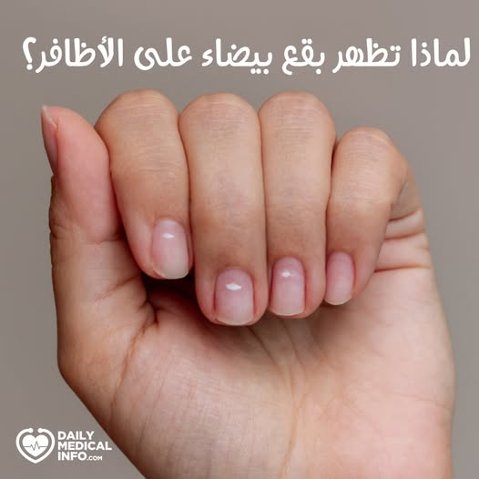 ما سبب ظهور البقع البيضاء على الأظافر؟ 1-السبب الأكثر شيوعًا هو صدمات طفيفة للأظافر، سواء نتيجة إجراءات العناية بالأظافر القاسية مثل برد الأظافر أو قص الجلد المحيط بالأظافر، أو النقر المفرط باليدين والأصابع على سطح صلب 2-في بعض الحالات، قد تظهر مناطق بيضاء وجافة على الأظافر عند ترك طلاء الأظافر لفترة طويلة أسابيع أو أكثر مما يمنع الظفر من تجديد خلاياه بشكل طبيعي. 3-كما يمكن أن يكون عدوى فطرية سببًا للبقع البيضاء، حيث تتكوّن طبقة بيضاء قد تغطي بعض المناطق أو كامل الظفر. 4-الحالات الأكثر خطورة قد تجعل نصف الظفر أو أكثر يظهر باللون الأبيض، وتشمل: -انخفاض مستويات الحديد في الدم. #-أمراض_الكلى. 