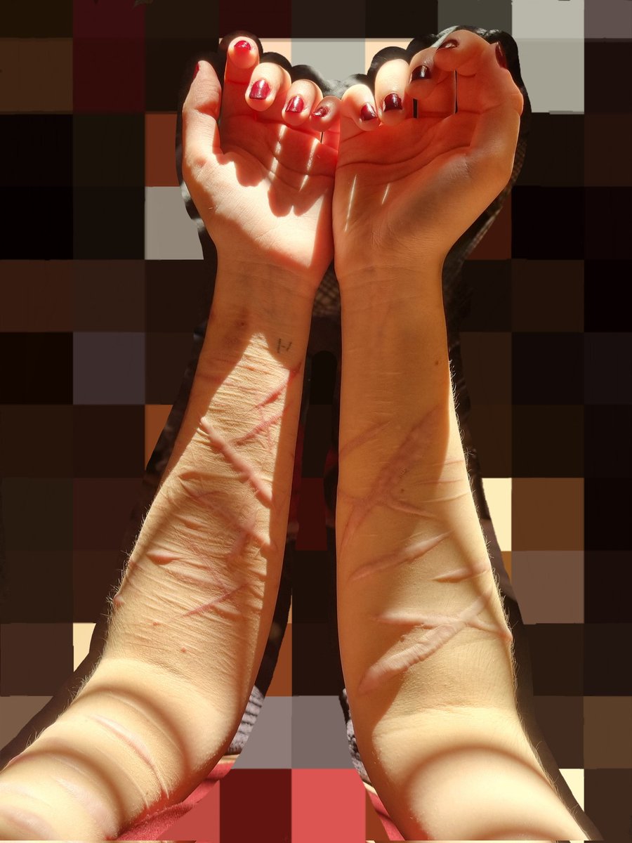 xiixiing's tweet photo. on a more positive note, didnt hate my scars for once this morning https://t.co/HcXRcUsK3g
