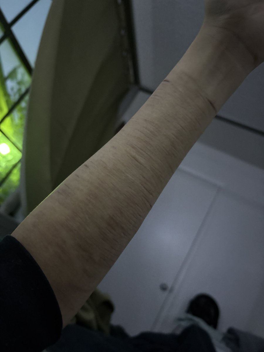 sunoocals's tweet photo. so i guess these scars will be on my body forever https://t.co/5LFWKjgQds