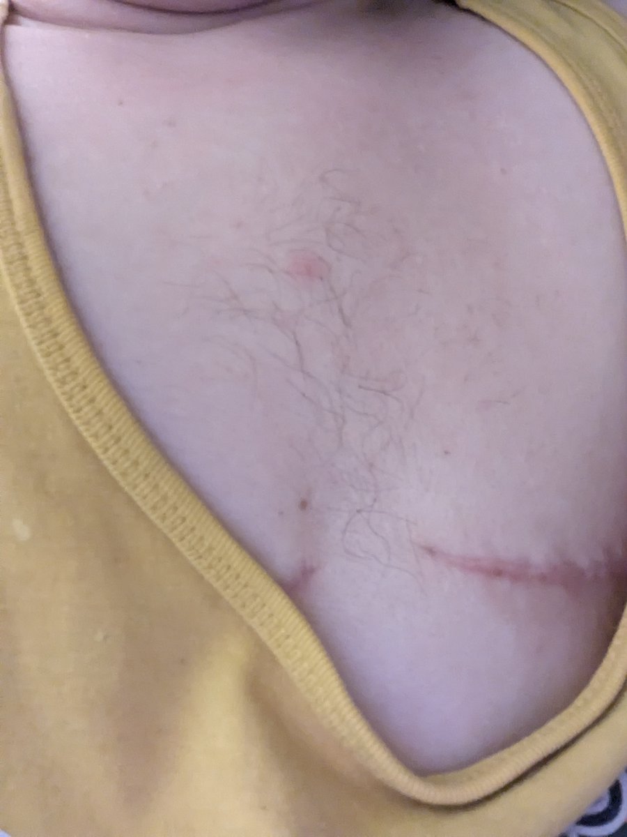 Yoooooo I got SLIGHTLY more chest hair! (Don't mind the acne, need to find a way to settle the HRT breakouts)