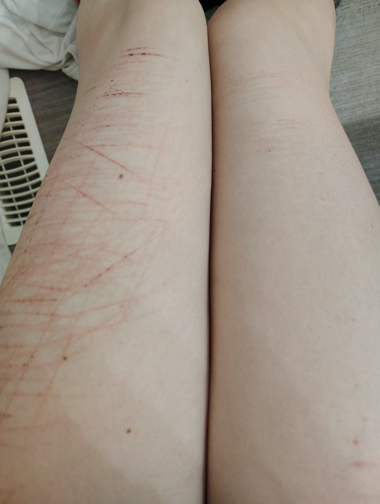 tresboruchechez's tweet image. these are mostly all healed but the difference is insane

yes i was peeing✌️