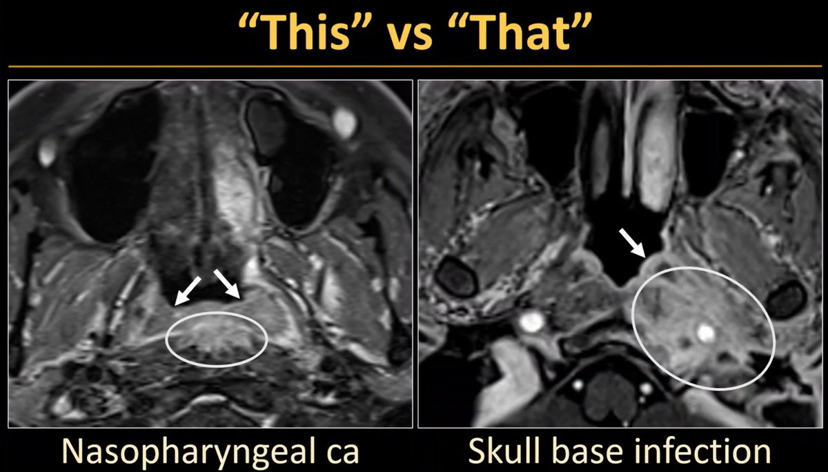 HeadNeckRads's tweet photo. Even though we're not mucosa doctors, we can still look at the mucosa to guide our differential and certainty. Here, carcinoma involves mucosa, whereas skull base osteomyelitis related inflammation spares mucosa.

@pbunchmd at #RSNA25 https://t.co/gjUSOiNbAP