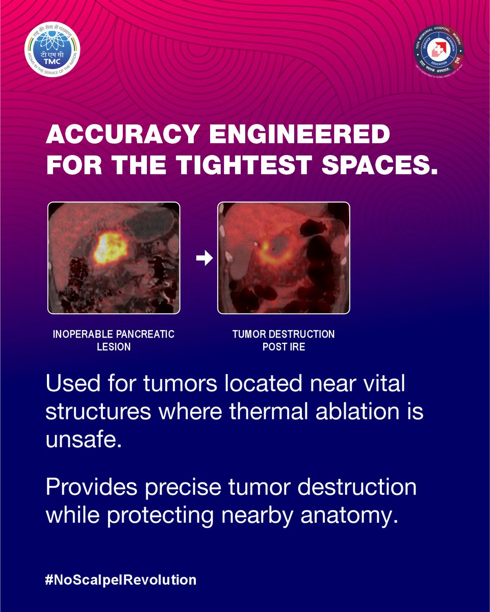 TataMemorial's tweet photo. Irreversible Electroporation destroys tumors using electric pulses while preserving vital structures like vessels & nerves. We have performed 50+ IREs for tumours in delicate locations, where surgery & thermal ablation were not feasible #NoScalpelRevolution #TataMemorialHospital https://t.co/LxsT152fQt