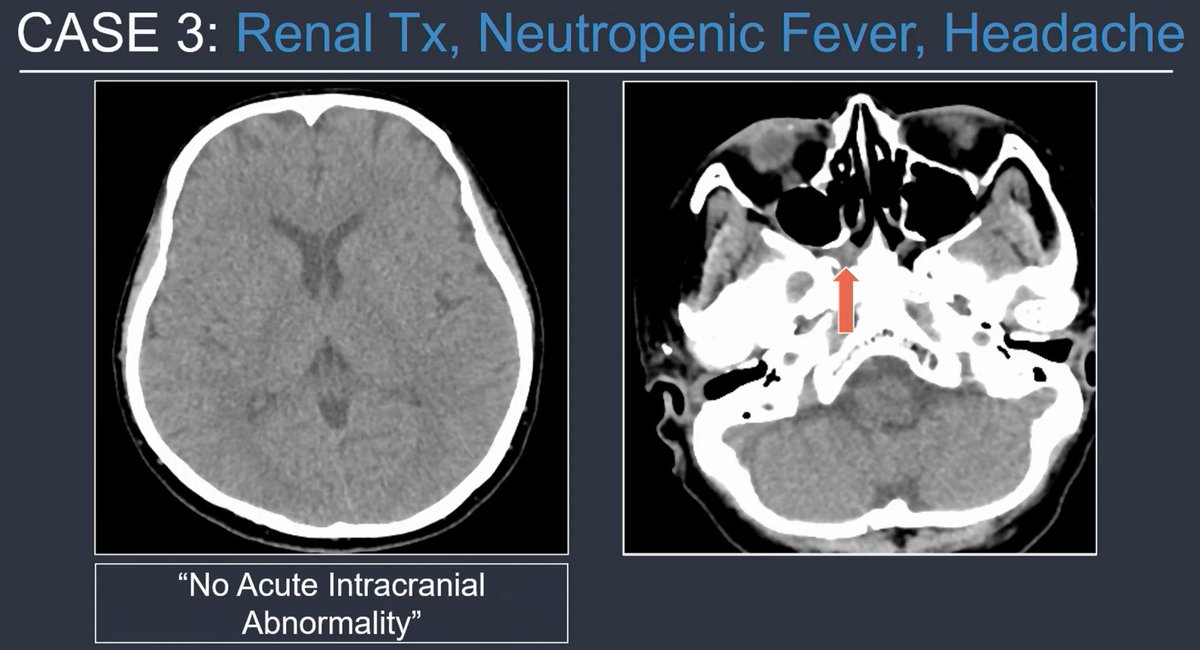 HeadNeckRads's tweet image. Immunocompromised patient, headache, head or face CT. You see sphenoid mucosal thickening.

Scrutinize the fat spaces. 👀

This was a case of invasive fungal sinusitis. The right pterygopalatine fossa is infiltrated. 🚩
I've seen this same miss!

@tabby_kennedy at #RSNA25