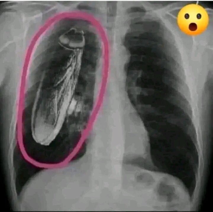 Abu_Jawaadd's tweet image. In a Kenya government hospital, a patient was x-rayed and was told that there was a live cockroach in his chest.  &quot;You will have to go to Singapore for treatment.&quot;
The patient went to Singapore and was told that the cockroach is not in his chest but inside the x-ray machine