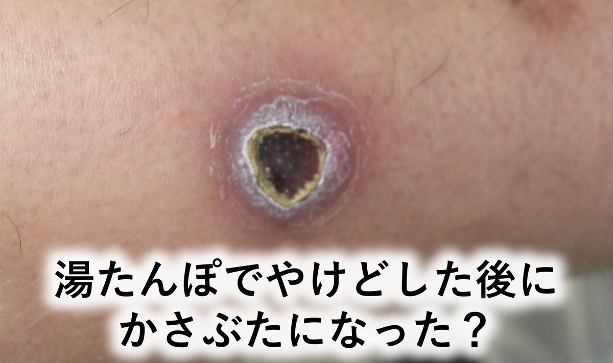 形成外科専門医がドキッとする言葉 →「湯たんぽでやけどした後に