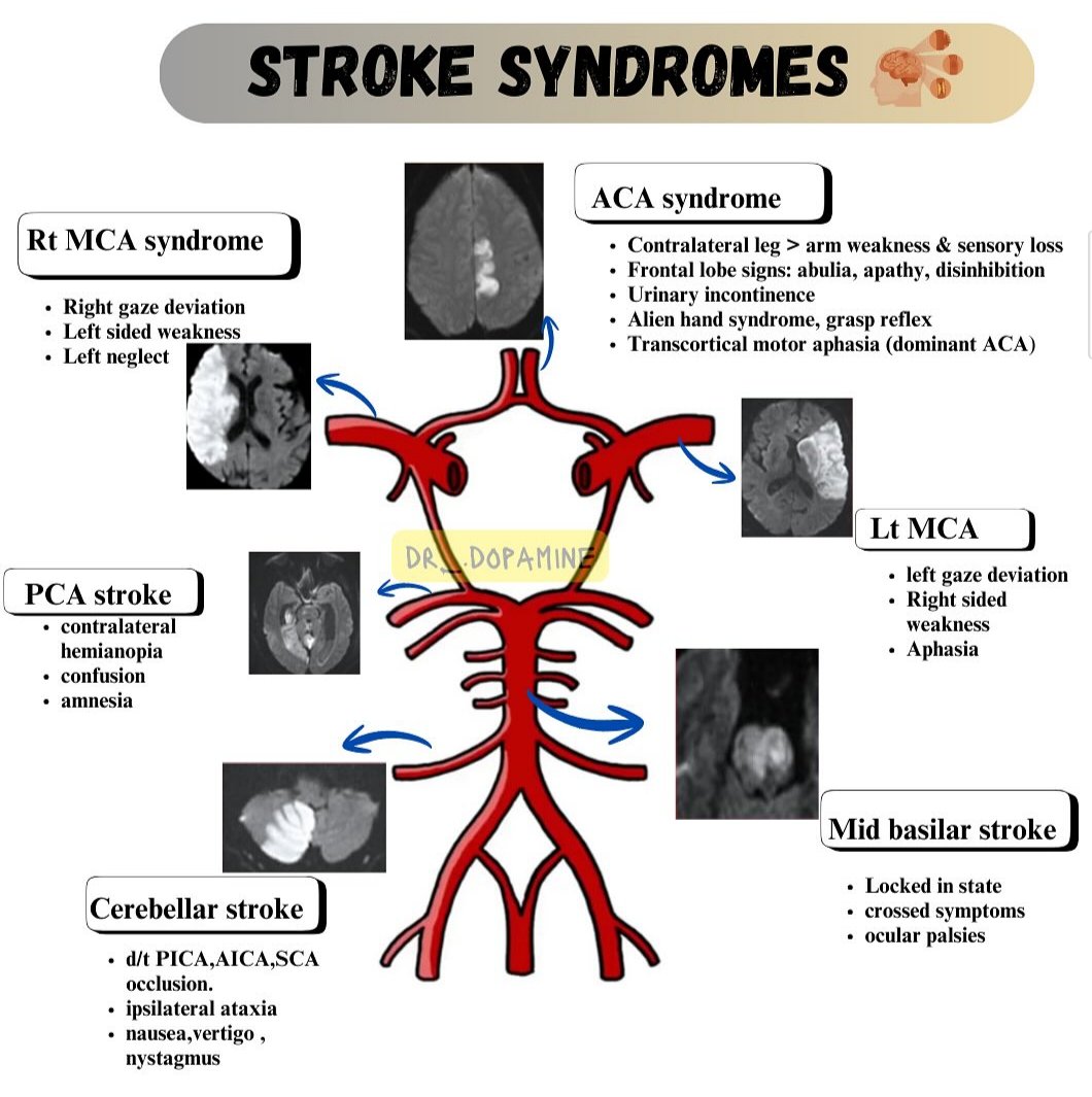 STROKE SYNDROMES