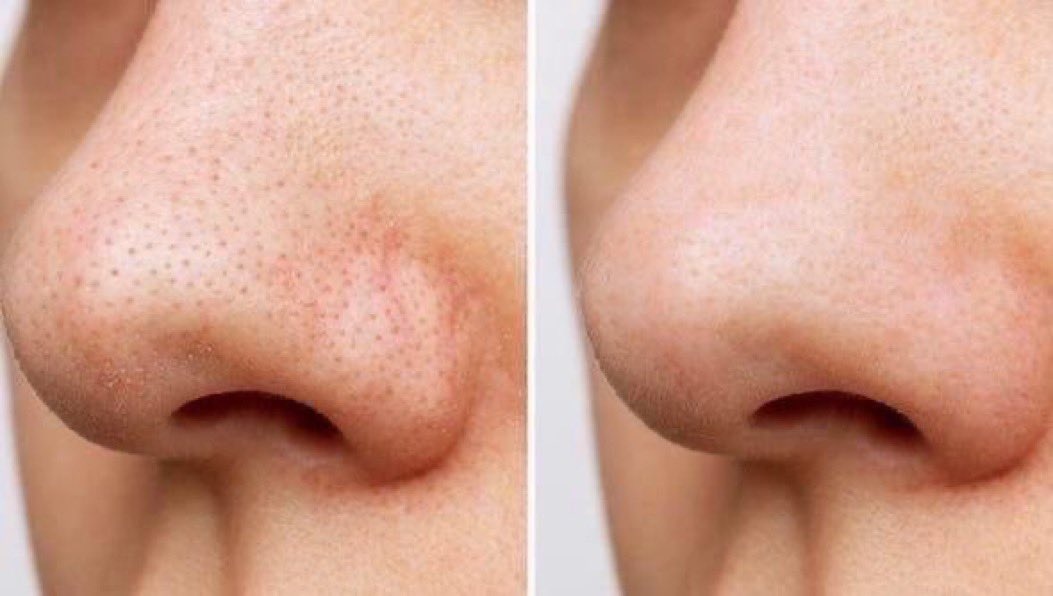 تبين انفك نظيف ويلمع بدون أي رؤوس سوداء، بهذا الثريد نصائح تخلصكم من الرؤوس السوداء الى الأبد ، فضلوها وتابعوا معاي 🧴🫧