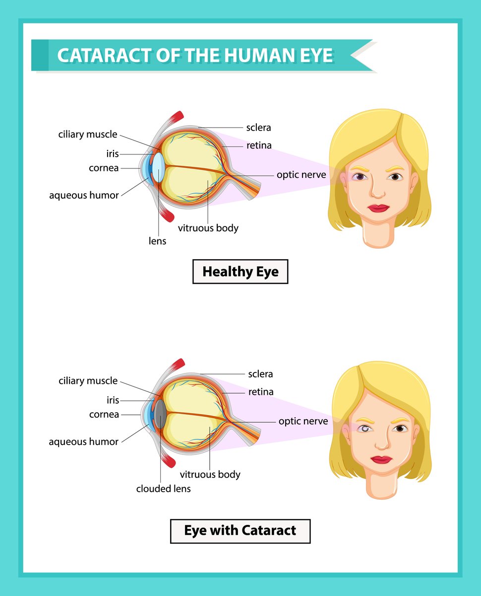 A cataract develops when the lens in your eye, which is normally clear, becomes foggy.

When a cataract clouds over the lens, your eye can’t focus light in the same way. This leads to blurry vision or other vision loss.

An eye examination can help us detect any vision issues.