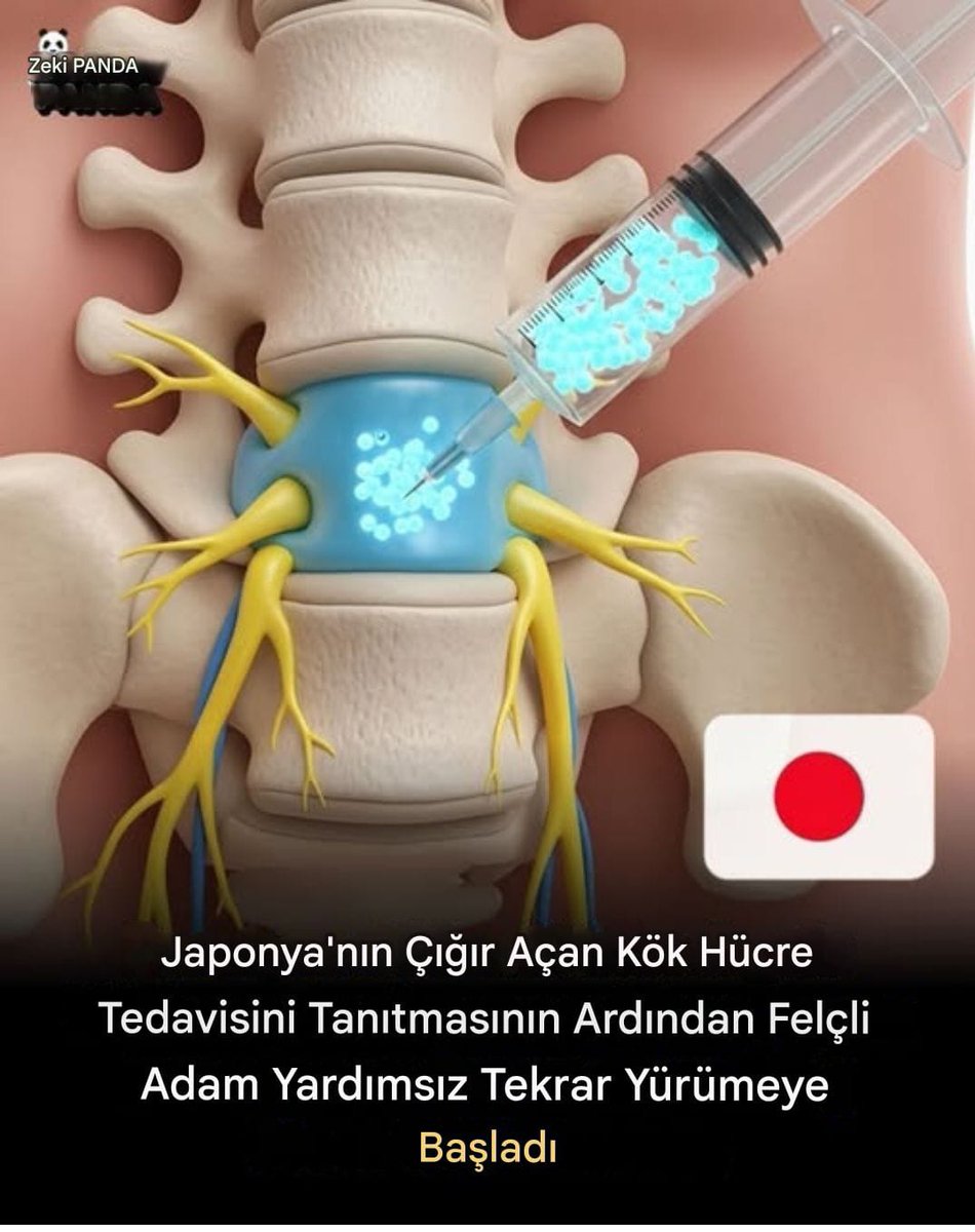 Japonya'da felçli bir adam, rejeneratif tıpta dünyada bir ilk olan öncü bir kök hücre tedavisi gördükten sonra yardımsız yürüme yeteneğini yeniden kazandı. Bu çığır açan tedavi, hasarlı omurilik dokusunu hedef alarak, daha önce kalıcı olarak kaybedildiği düşünülen hareket
