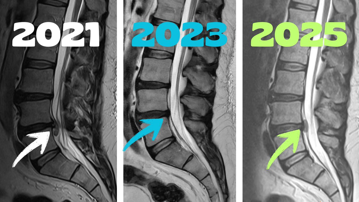 TDekkersPhysio's tweet photo. ⚡️Lightening can strike twice ....Recurrent disc herniations do happen 

This patient suffered an L4/5 Disc extrusion in 2021,  which completely resorbed by 2023, only to reherniate again in 2025.

Although he continued to have back pain in 2023 his findings showed a nearly pristine scan for his age group. 
In 2025 he started to developed left leg radicular pain due to the new herniation.

2 points here
1️⃣ Disc reherniations can occur at the same disc - even after obvious 'healing' has occurred.

2️⃣ Pain can remain even though disc herniations resorb (and vice-versa)