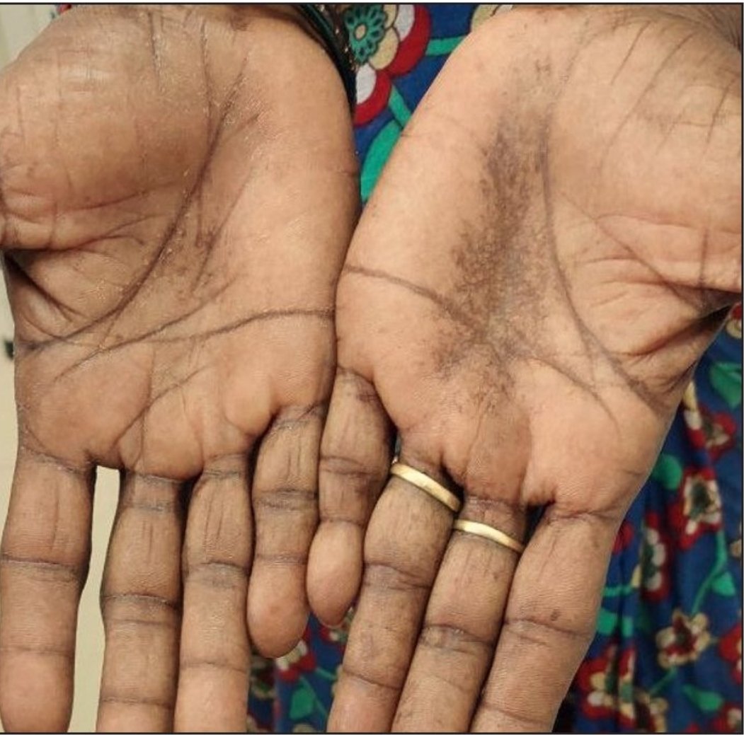 SugarDocHealth's tweet photo. If you’re always tired, weak, and notice your palms or knuckles are darker than usual, this thread is for you. 🖐️
Read to the end, it could help you or someone you love.
#AddisonsDisease #HealthAwareness https://t.co/sqqOSkPGbL