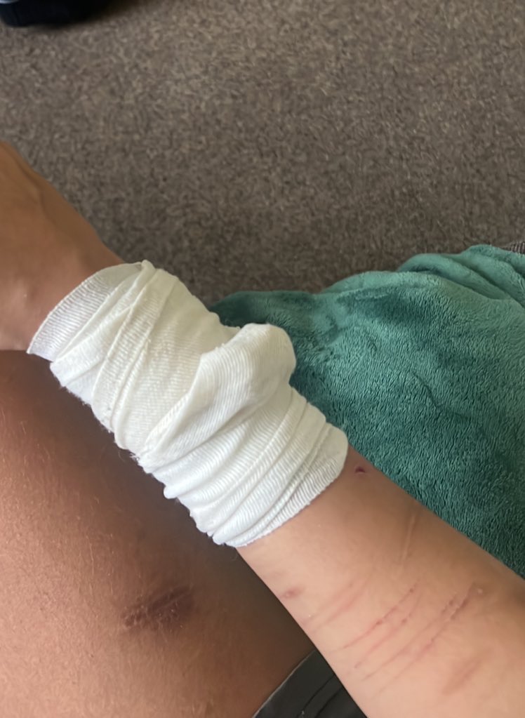 defnotsoberr's tweet photo. @tth3bl4ckestd4y tw sh
im feel u twin (i only had to go to the er for stitches and antibiotics but i could go home afterwards fortunately, im so sorry you had to stay and get admitted) hope you feel better soon and get discharged, i love you so much ki<3 https://t.co/wsrrcvrCu8