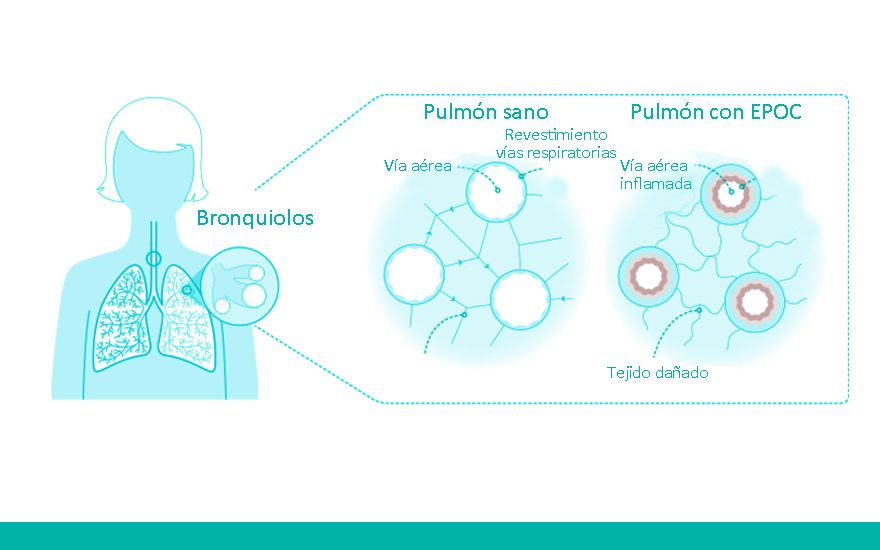 ¿Se puede curar la EPOC? Es una enfermedad crónica, pero un buen cuidado evita que progrese y mejora su calidad de vida. Aprende más en la #EscuelaEPOC de <a href="/QS_Madrid/">Hospital Universitario Quirónsalud Madrid</a> buff.ly/OFkdKIA