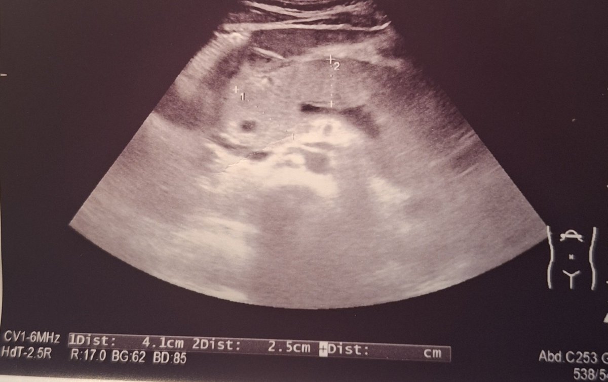 Воспаление поджелудки прямо как по учебнику. Давно такой здоровенной не видела