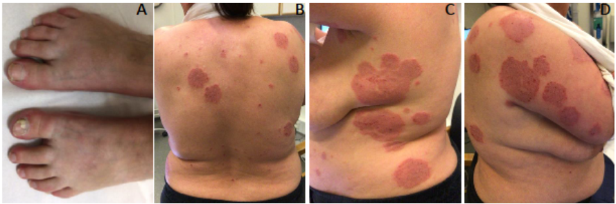 jofdermatology's tweet photo. Widespread Dermatophytosis in A Ukrainian Patient with AIDS: A Case Report
Read: https://t.co/OVP7ZD3o4K
#Dermatophytosis #PersistentRash #CerebralToxoplasmosis #Dermatology #SkinCare #DermTwitter https://t.co/Ba1QlA1mvt