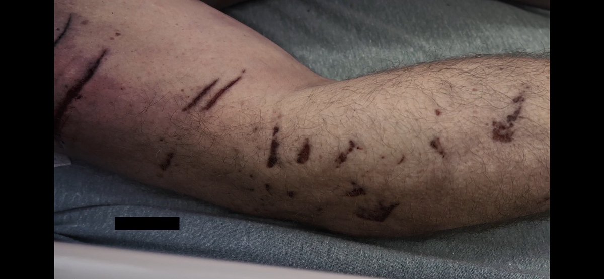 The Anti-Karen Read crowd won’t like this because it involves facts:
If these marks are from a dog and not a car, the case against #karenread falls apart. And claiming that these injuries came from a car and not from a dog is literally insane. Like claiming the earth is flat.