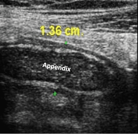 POCUSAcademy's tweet photo. Our case of the week has been posted! Follow us on LinkedIn, Instagram, or Facebook to review the case + share your answer.
LinkedIn: https://t.co/ldln0DoypN
Instagram: https://t.co/EQPTA2dORB
Facebook: https://t.co/JKibukTb8A
#POCUSCaseStudyChallenge https://t.co/puDKGZp5p9
