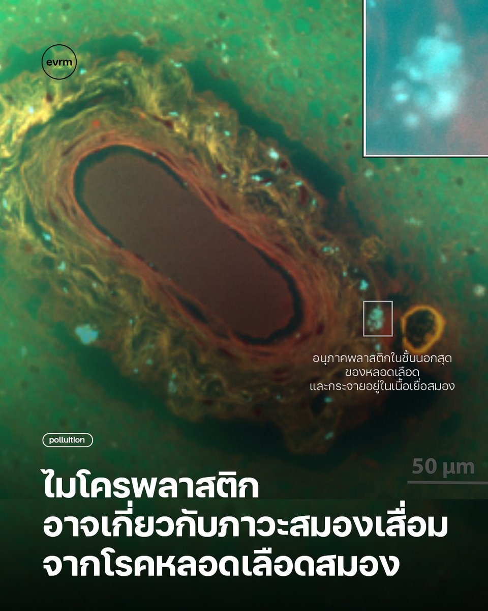 environmanth's tweet image. ◉ POLLUTION: ไมโครพลาสติกอาจเกี่ยวข้องกับภาวะสมองเสื่อมจากโรคหลอดเลือดสมอง (Vascular Dementia) ซึ่งเป็นหนึ่งในภาวะที่พบบ่อยที่สุด อาจมีสาเหตุจากมลพิษที่อยู่รอบตัวเรา
.…