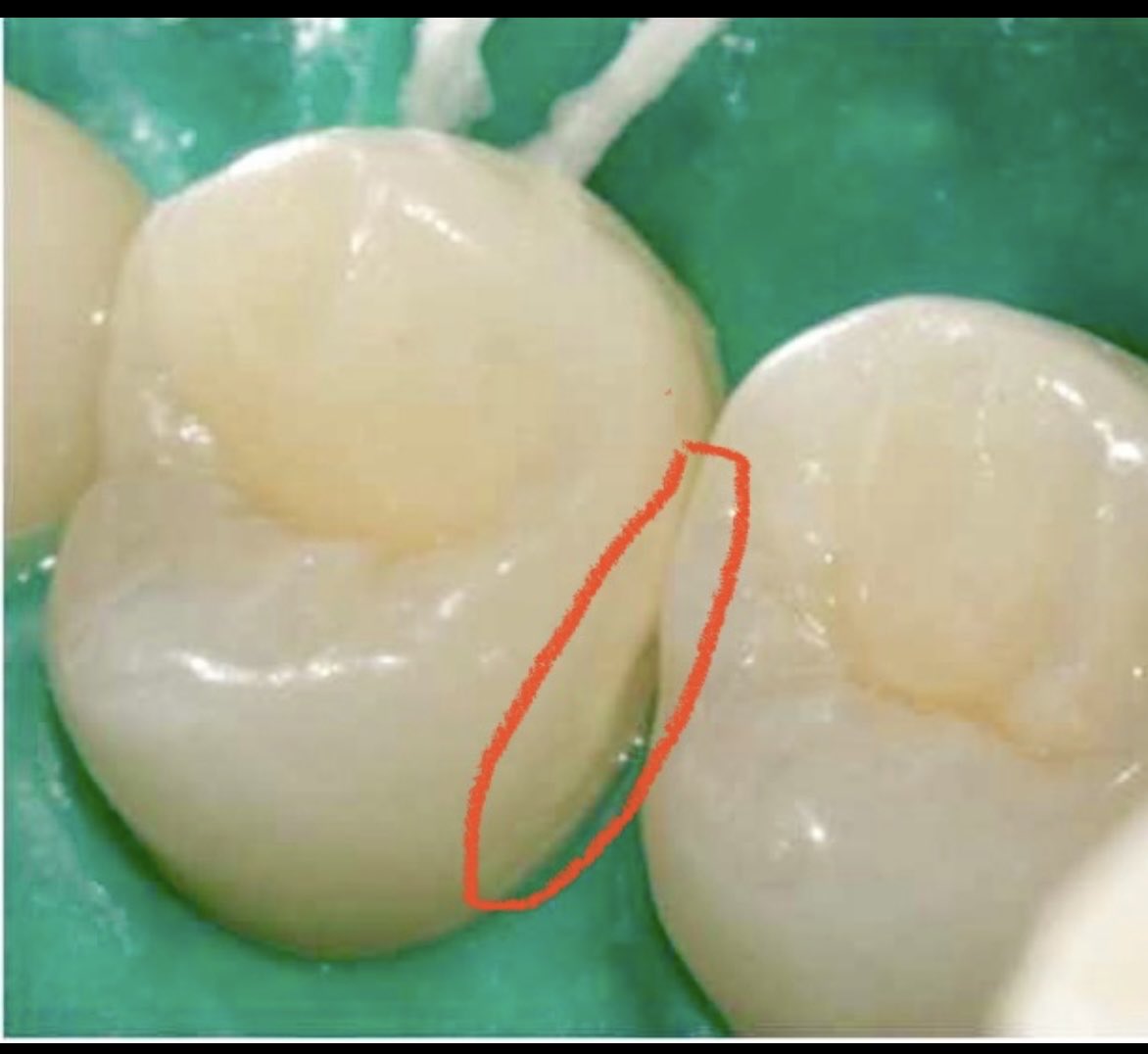 Don’t ask a dentist if they would restore/fill incipient decay

Ask a dentist if they would restore/fill incipient decay in their mother’s mouth… 

This would be unethical to treat. Way too many do…