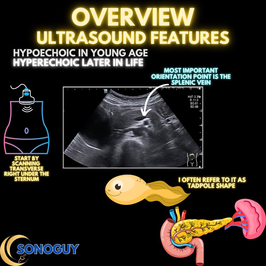 The_sonoguy's tweet image. 🎥 Pancreas Anatomy 101 - Master the pancreas, and half of abdominal ultrasound suddenly makes sense!

The pancreas is small, but scanning it is big work.
Here’s a quick refresher on what you’re actually looking at under the probe