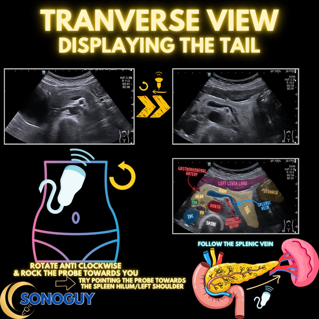 The_sonoguy's tweet image. 🎥 Pancreas Anatomy 101 - Master the pancreas, and half of abdominal ultrasound suddenly makes sense!

The pancreas is small, but scanning it is big work.
Here’s a quick refresher on what you’re actually looking at under the probe