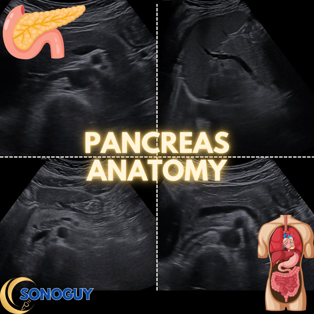 The_sonoguy's tweet image. 🎥 Pancreas Anatomy 101 - Master the pancreas, and half of abdominal ultrasound suddenly makes sense!

The pancreas is small, but scanning it is big work.
Here’s a quick refresher on what you’re actually looking at under the probe