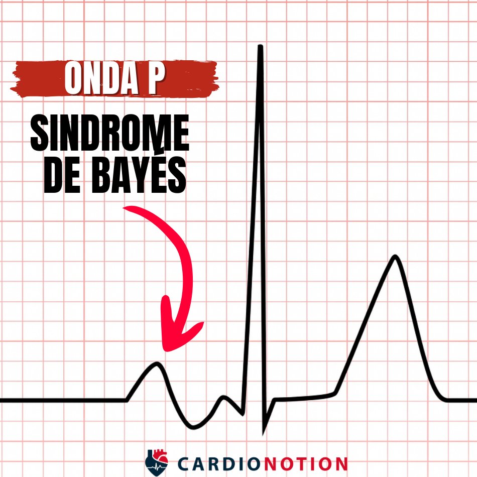 AppCardioNova's tweet photo. 1/ 🧵 ¿Conoces el Síndrome de Bayés? 

Un hallazgo sutil en el ECG que puede aumentar el riesgo de arritmias como la Fibrilación Auricular.

Te lo explicamos con imágenes en este hilo 👇 
#ECG #SíndromedeBayés #CardioEd #MIR #2MIR26 #ENARM #Medicina https://t.co/oNp8CZ3afY