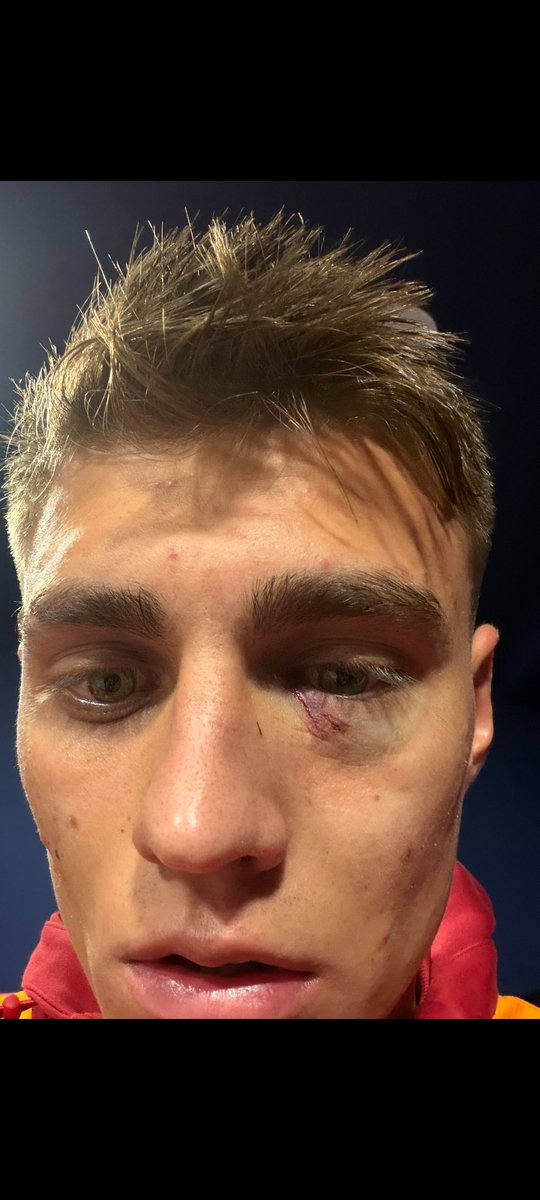 Program başlayalı 30 dakika oldu,utanmadan şu fotoğrafı vermediniz. Kazımcan Karataş gözünü kaybedecekti belki bir geçmiş olsun demiyor bu olayı gündeme getirmiyorsunuz... #derinfutbol