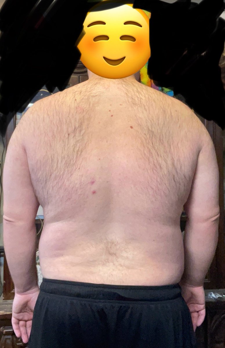 Start of weight loss and body transformation. 

December 1, 2025
Weight: 292.9
BMI: 42.0
BF%: 39.5%
Neck: 18-1/4”
Chest: 51-1/4”
Waist: 52-1/2”
Hip: 48”
Bicep: 16-1/2”
Forearm: 13-1/4”
Thigh: 38”
Calf: 18”