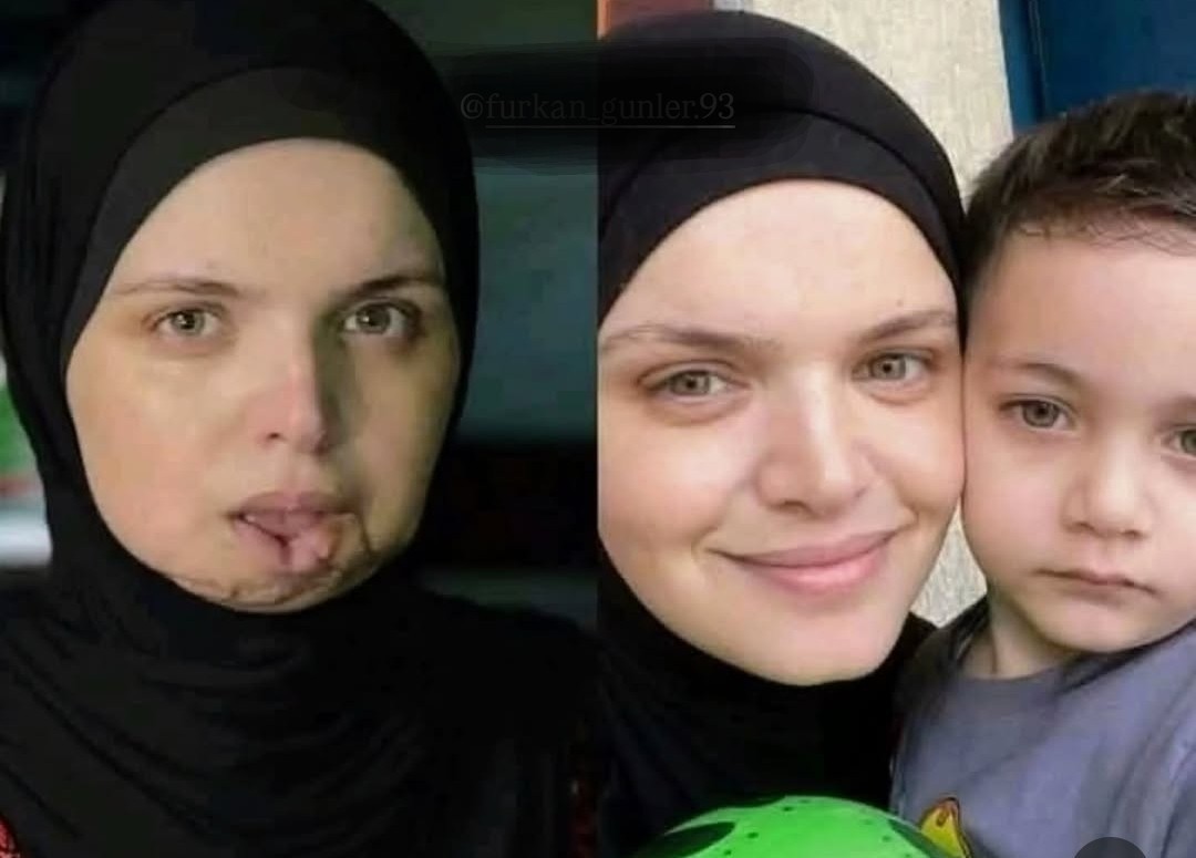 Bu gönderiyi yayalım. 
#Boykot'u delenler ve hiç yapmayan ezik aşşağılık kompleksli canavar zihniyetliler. 
Utanın dicem de yüzünüz yoktur.

Alt çenesinden vurulmuş bir anne konuşuyor.
Üç evladını-Rital'i, Usame'yi ve Nur El Hak'ı-bir anda toprağa vermiş bir yürek anlatıyor.