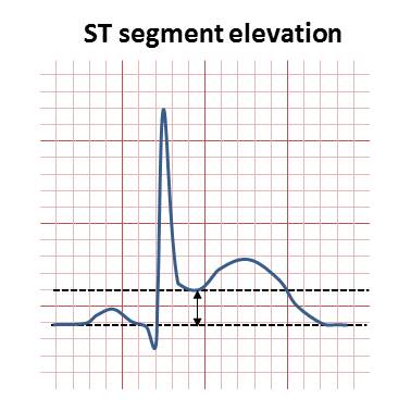 TrackYourHeart's tweet photo. The minimum ST elevation criteria for diagnosing STEMI in limb leads is:
a) ≥0.5 mm in 2 contiguous leads
b) ≥1 mm in 2 contiguous leads
c) ≥2 mm in 2 contiguous leads
d) ≥3 mm in 2 contiguous leads https://t.co/hTDCWjw2mW