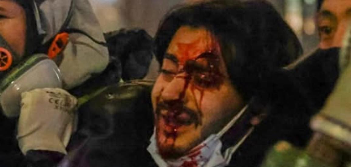 BBC’s recent 50-minute investigation into last year’s brutal crackdowns in Georgia doesn’t include one of the most horrifying stories — that of Aleksi Tirkia, a young protester who was struck in the face by a tear-gas canister and barely survived.

He suffered an open scalp