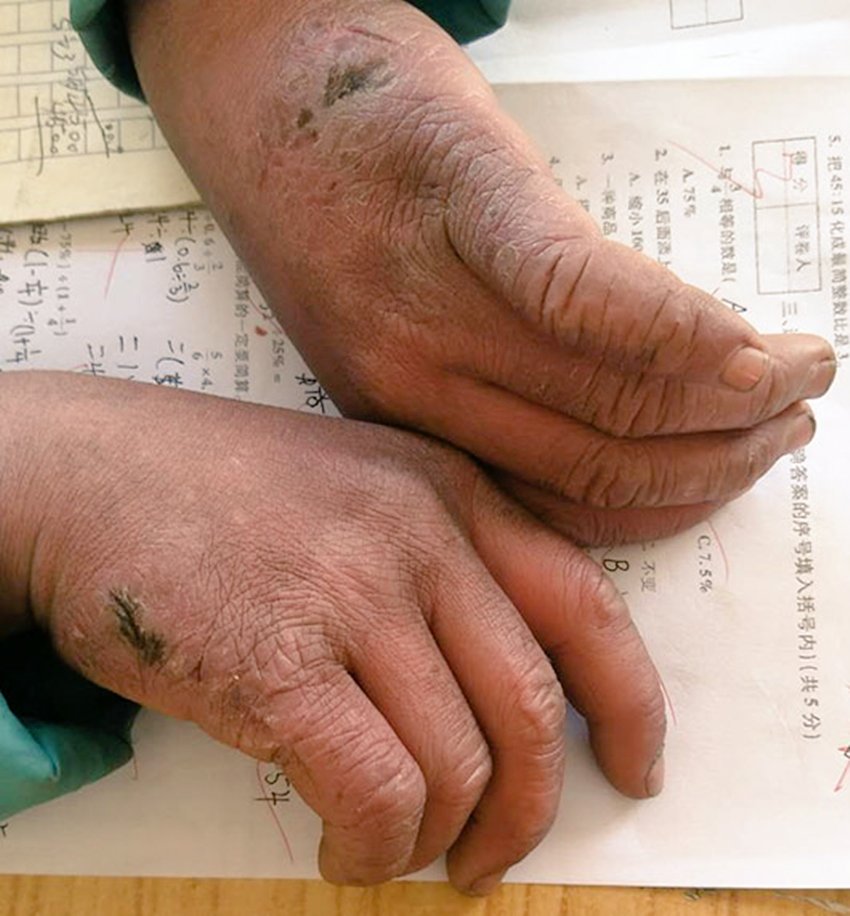 Firozakpathan's tweet image. -9 डिग्री में 3 मील चला बच्चा, सिर पर जमी बर्फ

चीन का 8 साल का वांग फ्यूमन उस सुबह अकेला निकला था. रास्ता 3 मील लंबा, तापमान माइनस 9 डिग्री… हर कदम पर बर्फ उसके पैरों को जमा रही थी.

चलते-चलते उसकी भौंहों पर बर्फ जम गई, बाल सफेद हो गए, गाल ठंड से जलने लगे. पर उसने रुकना नहीं…