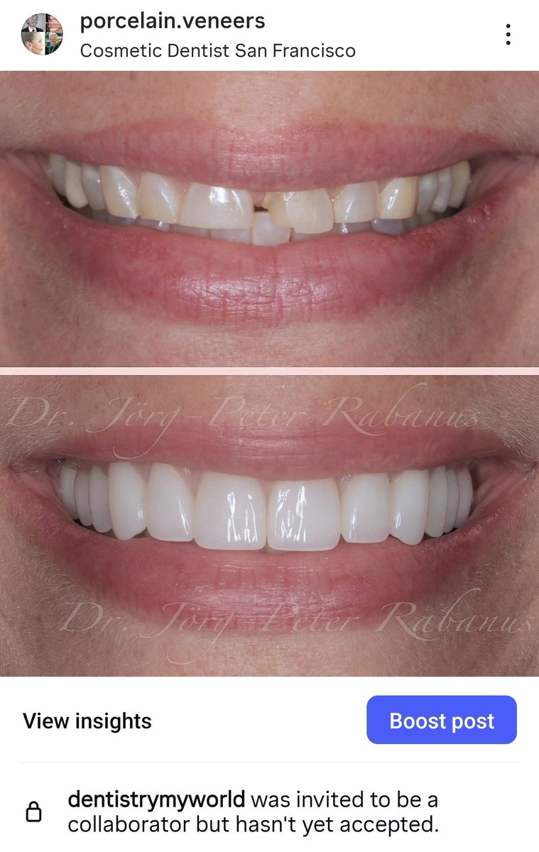 PeterRabanus's tweet photo. An extremely worn smile starts with a precise diagnosis, TMJ and muscle evaluation, CR records, and a diagnostic wax-up. A trial phase with temps confirms comfort, function, and aesthetics before completing the final porcelain restorations. https://t.co/wBrYZ9KdI9