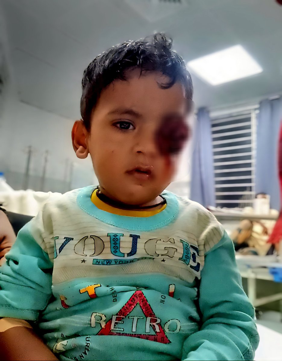 rco_org's tweet photo. URGENT APPEAL 🚨

Abdullah, only 2 years old, has been diagnosed with advanced eye cancer (Retinoblastoma). Doctors advised 5 chemotherapy sessions followed by eye surgery.
Estimated cost: $3000.

His parents are in tears, begging for help.
Your small donation can save his eye and his life.
If you cannot donate, please share to reach more hearts.

Donation link:
https://t.co/VMoFxF8rQH

Please keep little Abdullah in your prayers.