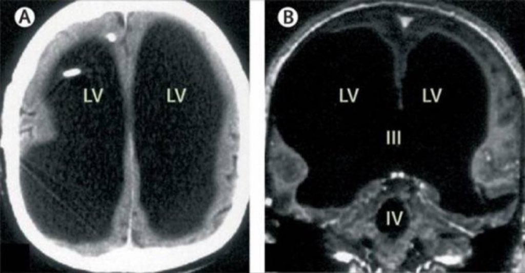 siradisi_bilim's tweet image. Beyni olmadan yaşayan adam bilim insanlarını şaşkına çevirdi. 🧠😱