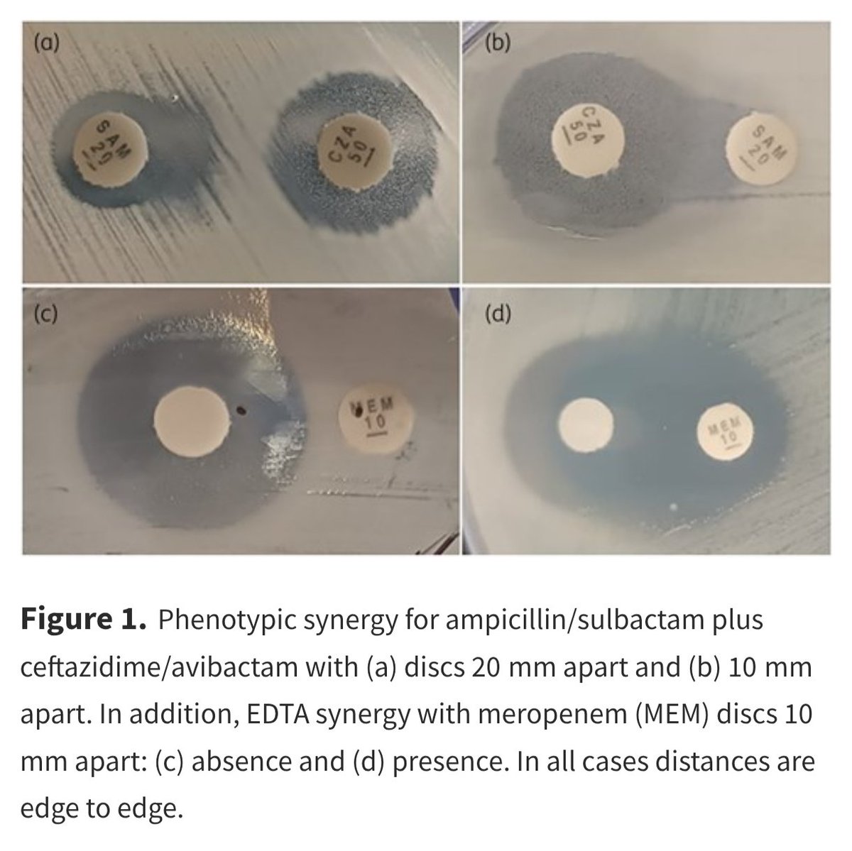 ABsteward's tweet photo. 🆕⚡🦀A New Twist — Once Again, Ceftazidime Avibactam Turbocharges Ampicillin Sulbactam Against CRAB | JAC-AMR 2025

🚀 What they did
🧪 In-vitro study of 184 CRAB isolates from 9 Peruvian hospitals (2018–2023).
🧬 Confirmed via blaOXA-51 PCR, MALDI-TOF, and 16S rRNA where needed.
💊 Tested ampicillin/sulbactam (SAM) + ceftazidime/avibactam (CZA) synergy using dual-disc diffusion (20 mm → 10 mm).
🧲 Screened for MBL using EDTA synergy; confirmed blaNDM by PCR.
📊 Compared synergy across susceptible / intermediate / resistant CRAB categories.
🔎 Stats via Fisher’s exact test.

🔥 Key findings
🧱 87.5% of isolates were AMP/SUL-resistant.
💥 97.3% overall synergy with SAM + CZA (97.2% in non-susceptible).
🧬 MBL (blaNDM) in 1.6% — poor/absent synergy (expected: avibactam doesn’t inhibit MBLs).
⚙️ One NDM isolate showed synergy at 10 mm → likely low MBL expression + serine β-lactamase inhibition.
🚫 Three non-NDM isolates lacked synergy → likely porin loss, efflux, or OXA-variants not inhibited by avibactam.

⚠️ Limitations
🔬 No MIC confirmation (no avibactam powder).
🧭 Possible MALDI-TOF misidentification in a minority.
🌍 All isolates were carbapenem-resistant → limits generalizability.
📦 Non-parallel isolate recovery → no evolutionary analysis.

💡 Takeaway
👉 Sulbactam/avibactam shows potent in-vitro synergy with CZA against CRAB, restoring activity even in resistant isolates.
🛡️ Especially useful in regions with CRAB prevalence >80% where options are scarce.
⛔ Limited activity against NDM producers — inherent class limitation.
📈 Supports future stewardship pathways for XDR CRAB, while clinical trials are urgently needed.
Could this become a salvage option for SAM non-susceptible CRAB isolates? #IDXposts
https://t.co/IUaUsTNAtw