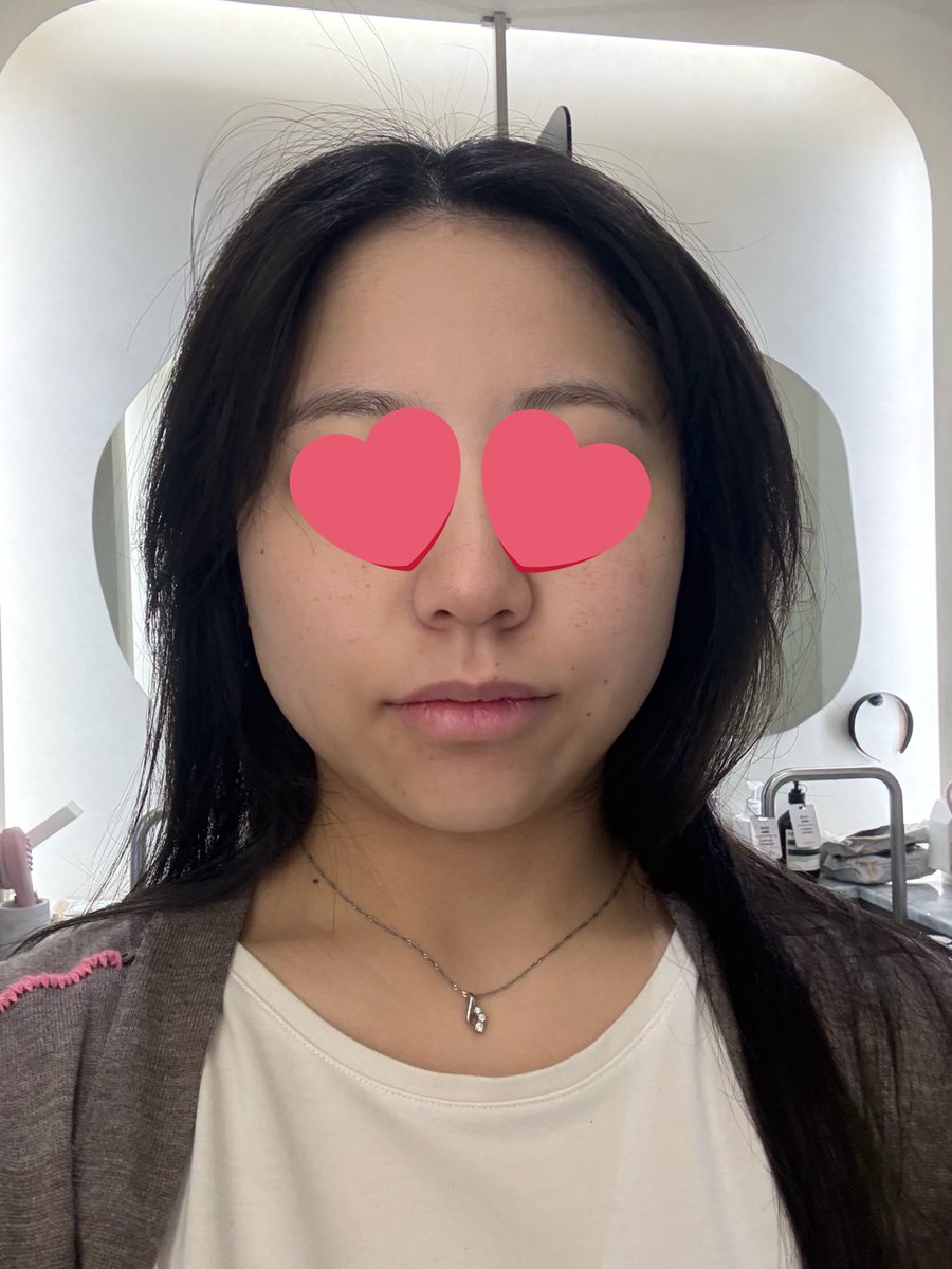 Mari_Won2000's tweet photo. ずっと気になってた”アクアピール＋LDM水分鎮静モード“受けてきた💆‍♀️
クレンジングだけじゃ取りきれない毛穴の詰まりを、優しく”水の力”でツルンと取ってから、LDMで水分補給＋赤みケア＋引き締めまで✨

終わった瞬間、肌のトーンも毛穴も明らかに違ってびっくり👀
スタッフさんも日本語堪能◎ https://t.co/ScJL06jjYg